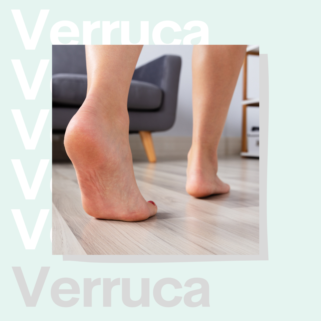 Verruca image Bare feet walking